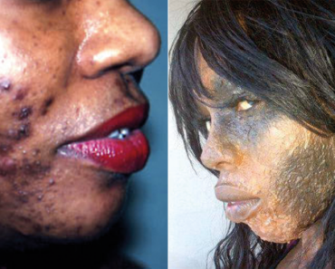 The Dangers of Skin Bleaching in Africa: Awareness and Prevention