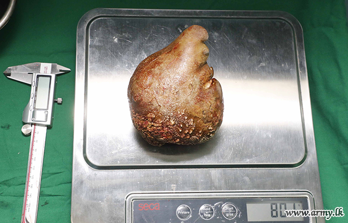 World's Largest Kidney Stone, Weighing 801g, Removed from Retired Soldier in Sri Lanka
